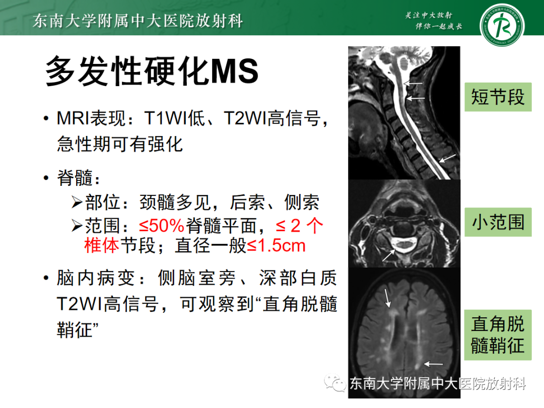 影像PPT - 【PPT】脊髓亚急性联合变性-25 影像PPT - 【PPT】脊髓亚急性联合变性-25