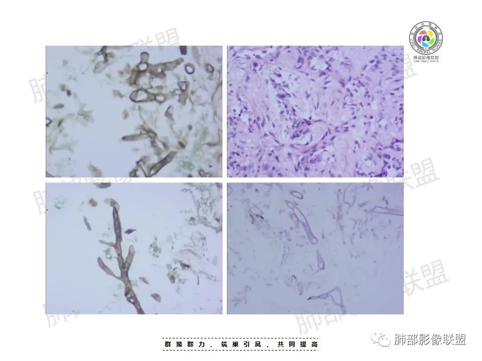 影像PPT - 【病例】影像经典之肺毛霉病-19 影像PPT - 【病例】影像经典之肺毛霉病-19