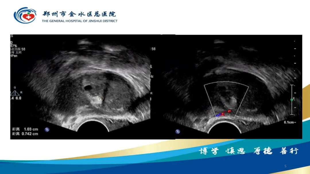 影像PPT - 【病例】巧克力囊肿-5