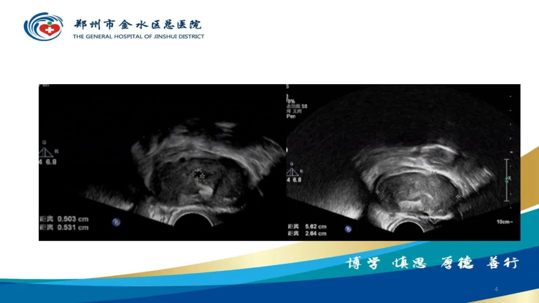 影像PPT - 【病例】巧克力囊肿-4