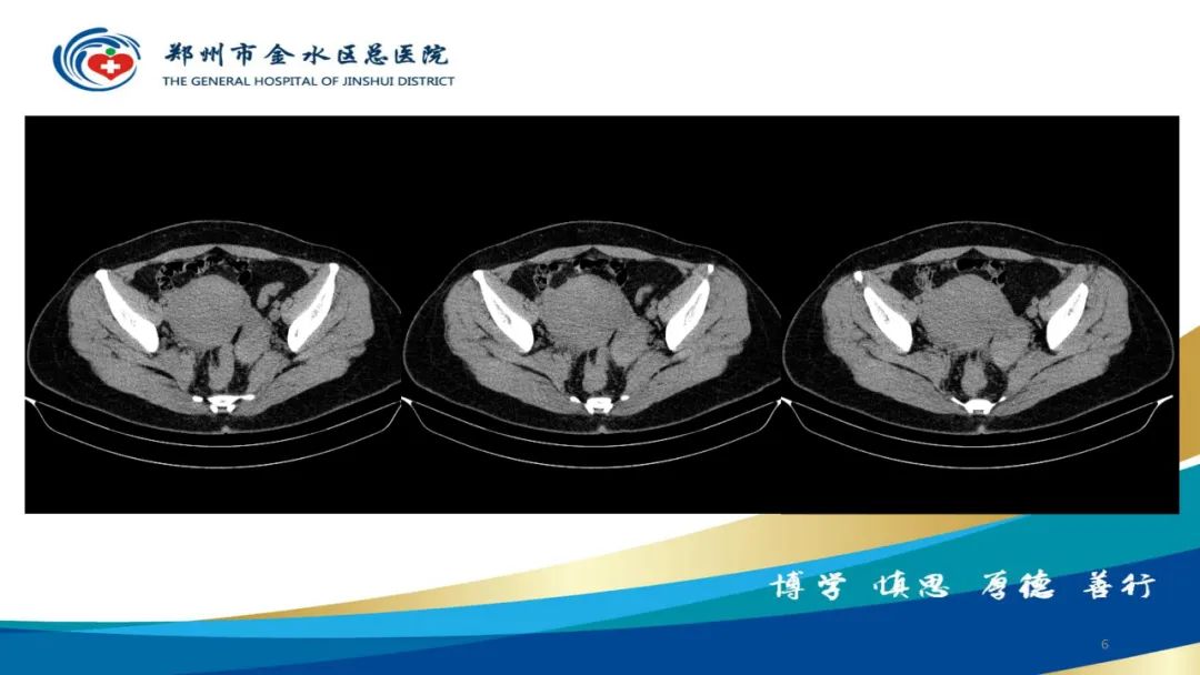 影像PPT - 【病例】巧克力囊肿-6