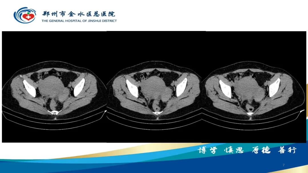 影像PPT - 【病例】巧克力囊肿-7