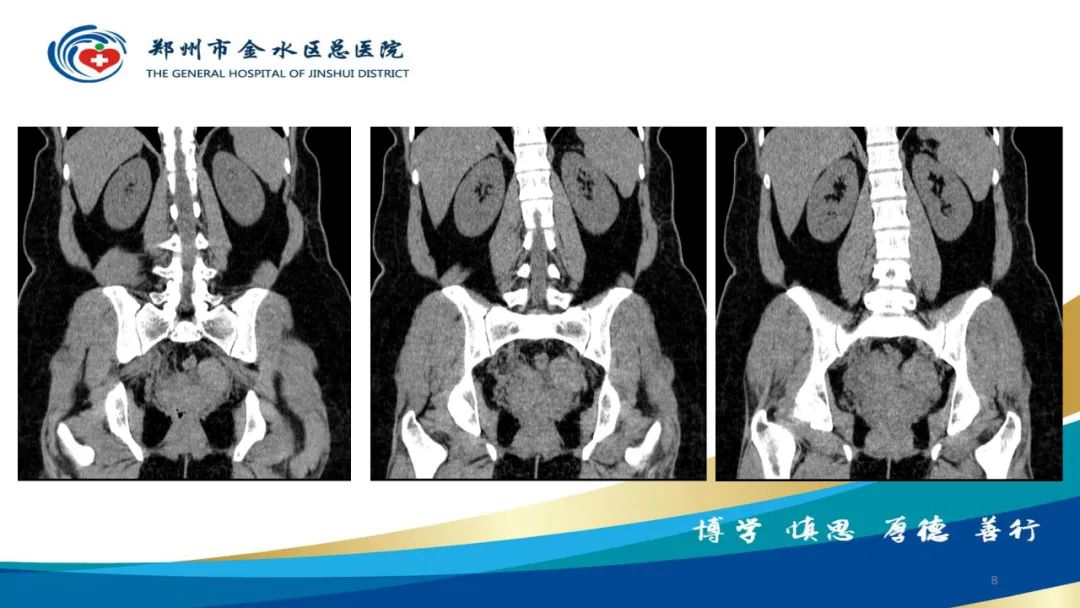 影像PPT - 【病例】巧克力囊肿-8