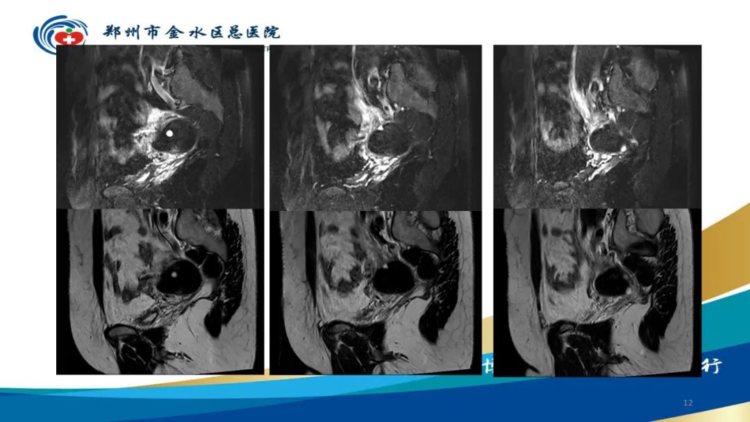 影像PPT - 【病例】巧克力囊肿-12