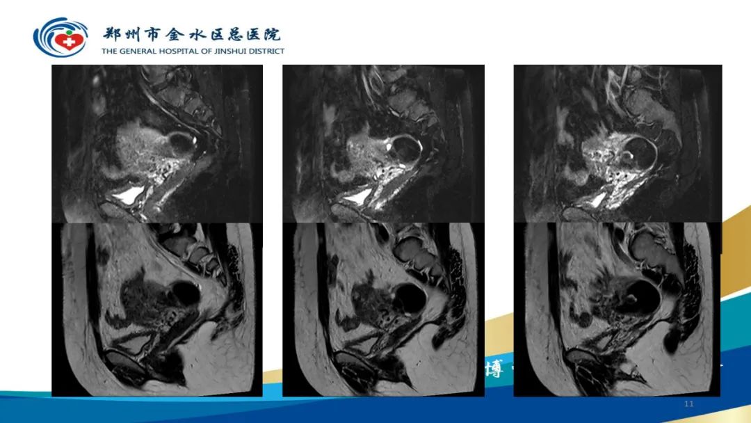影像PPT - 【病例】巧克力囊肿-11