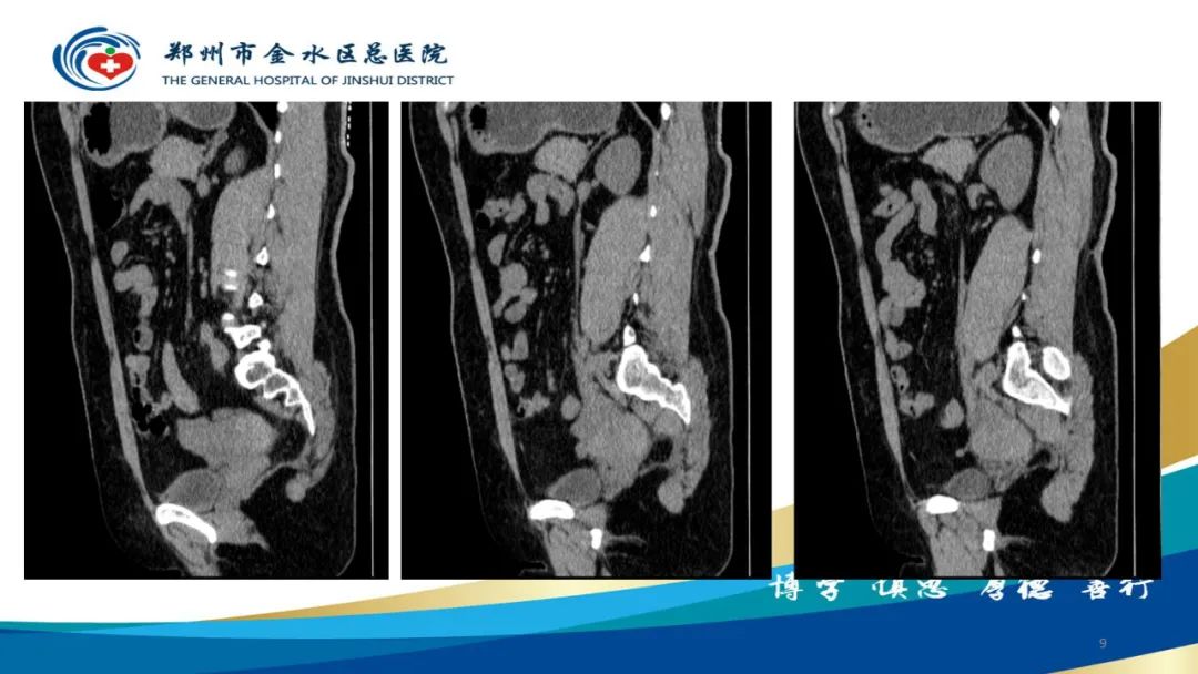 影像PPT - 【病例】巧克力囊肿-9