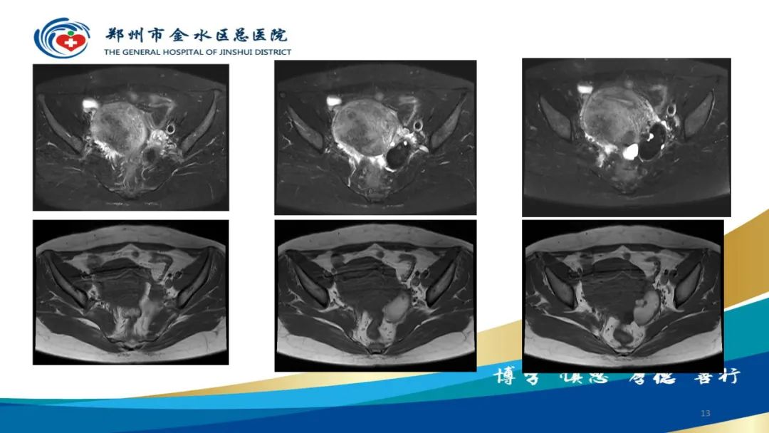 影像PPT - 【病例】巧克力囊肿-13