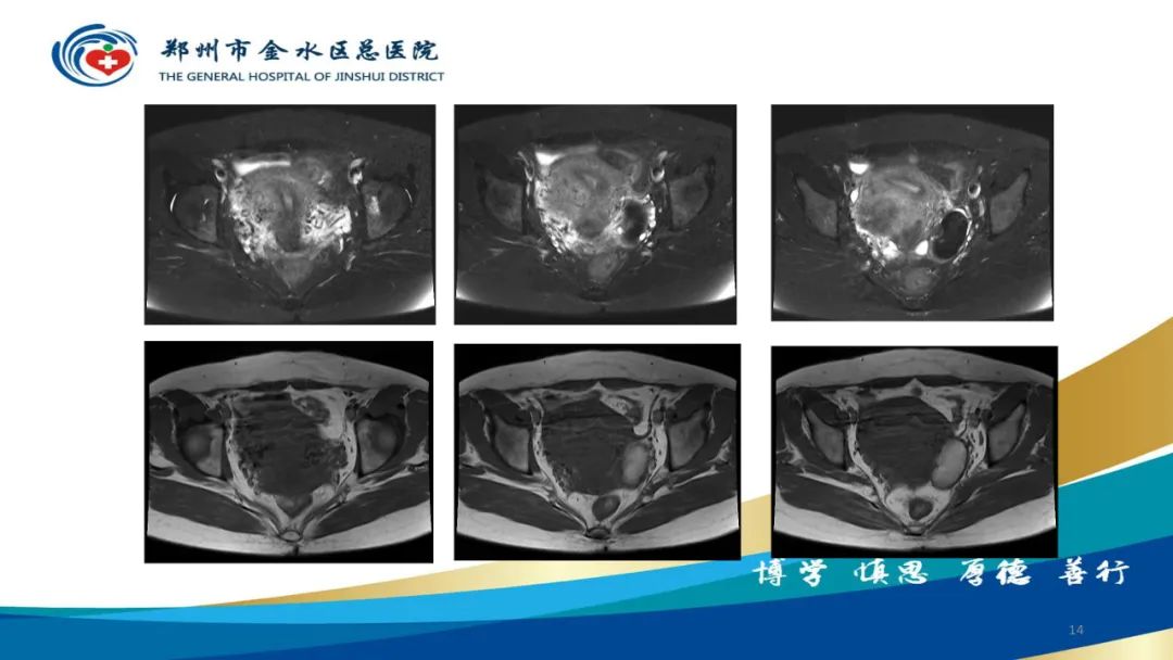 影像PPT - 【病例】巧克力囊肿-14