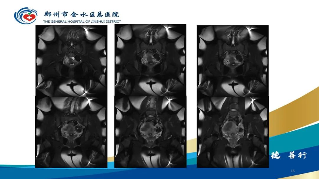 影像PPT - 【病例】巧克力囊肿-15