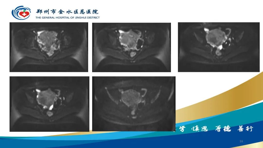 影像PPT - 【病例】巧克力囊肿-16