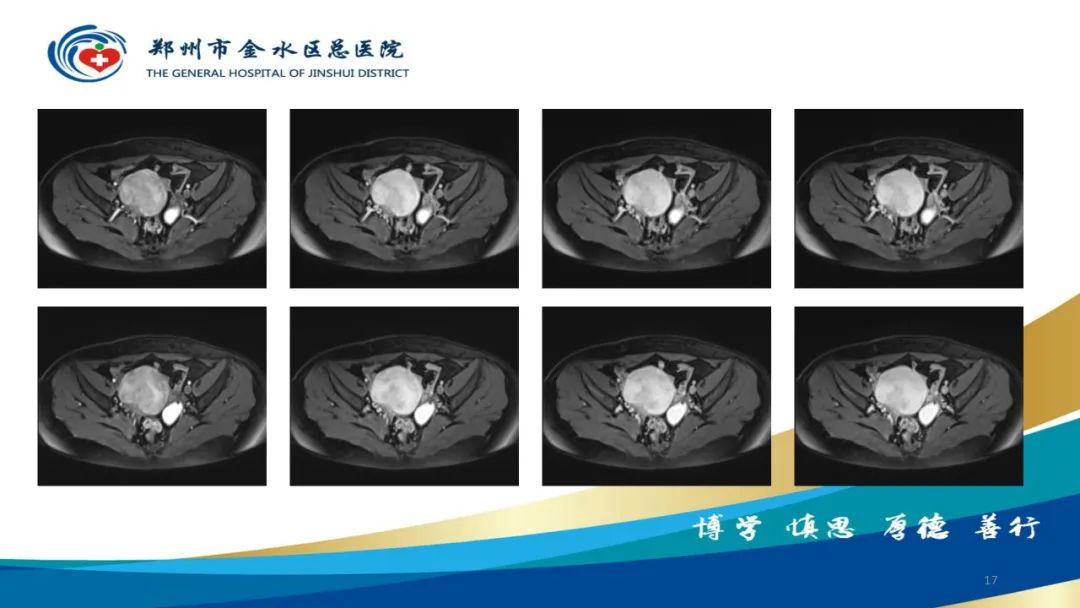影像PPT - 【病例】巧克力囊肿-17