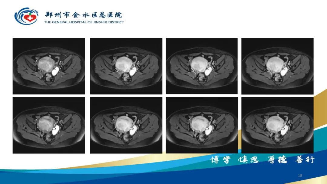 影像PPT - 【病例】巧克力囊肿-18