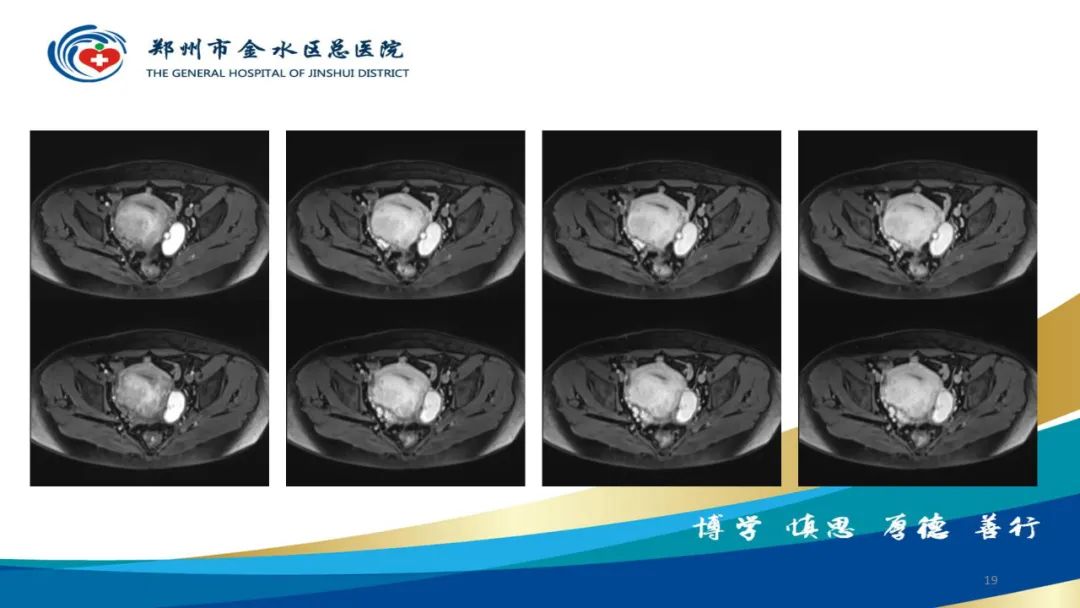 影像PPT - 【病例】巧克力囊肿-19