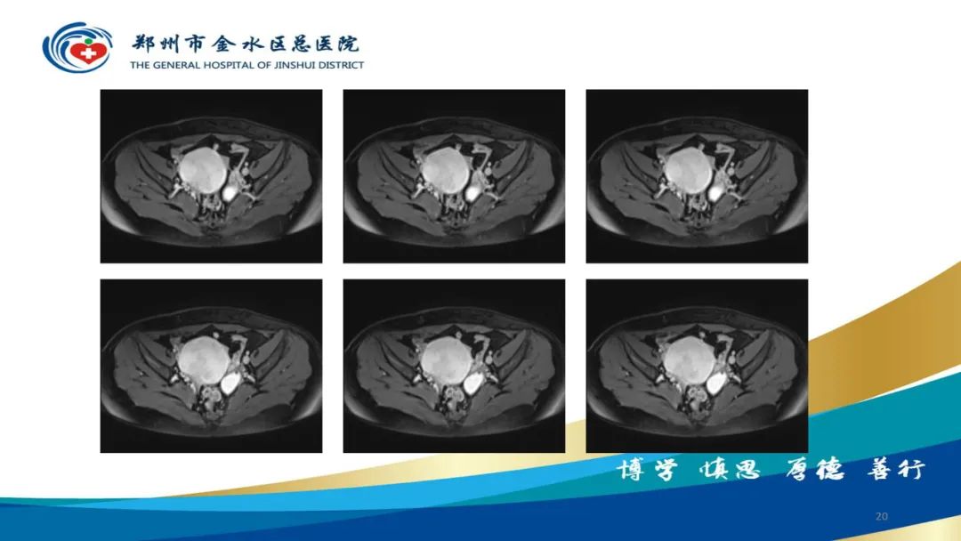 影像PPT - 【病例】巧克力囊肿-20