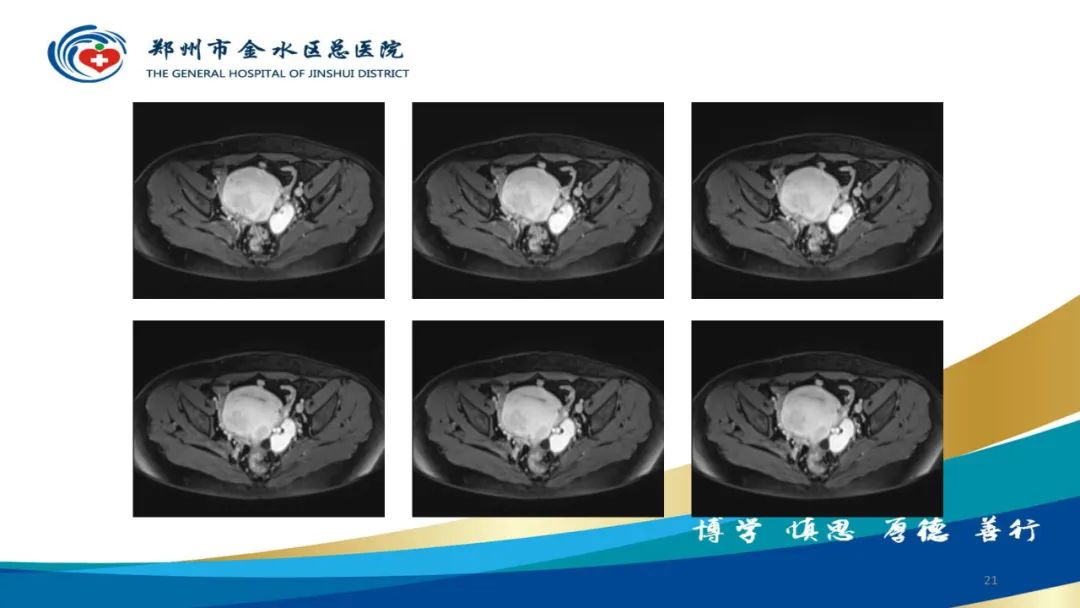 影像PPT - 【病例】巧克力囊肿-21