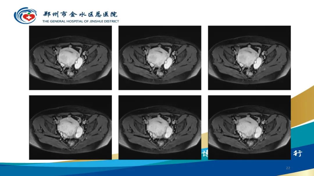 影像PPT - 【病例】巧克力囊肿-22