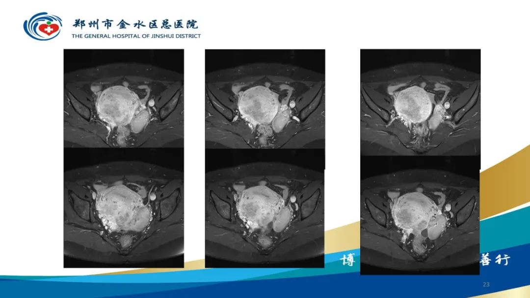 影像PPT - 【病例】巧克力囊肿-23