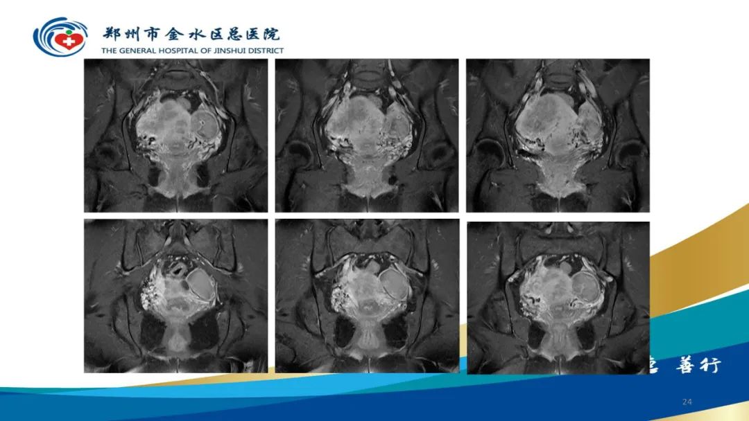 影像PPT - 【病例】巧克力囊肿-24