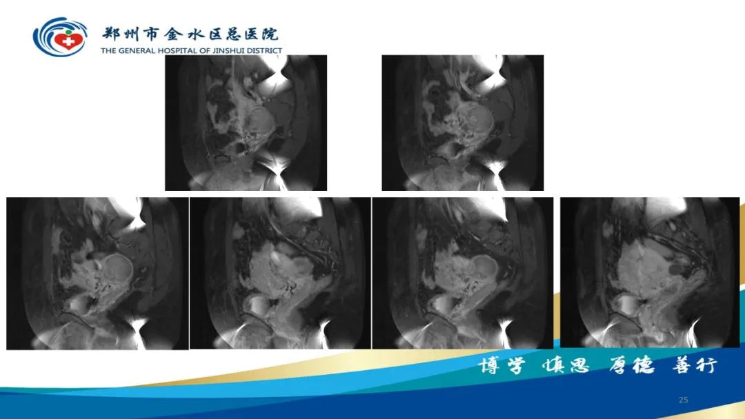 影像PPT - 【病例】巧克力囊肿-25