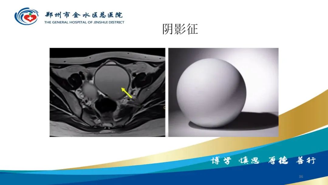 影像PPT - 【病例】巧克力囊肿-36