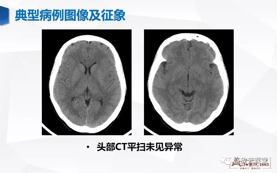 影像PPT - 【PPT】神经系统特殊感染（病毒性脑炎）-4