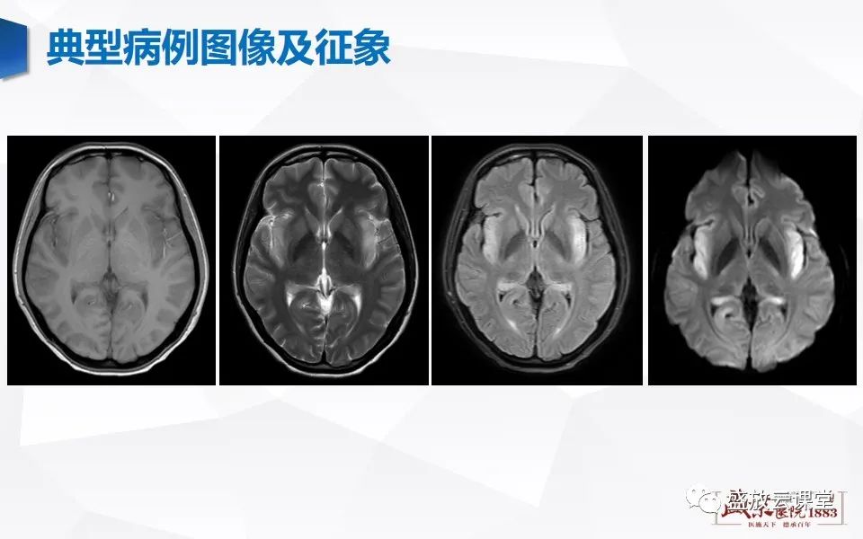 影像PPT - 【PPT】神经系统特殊感染（病毒性脑炎）-6