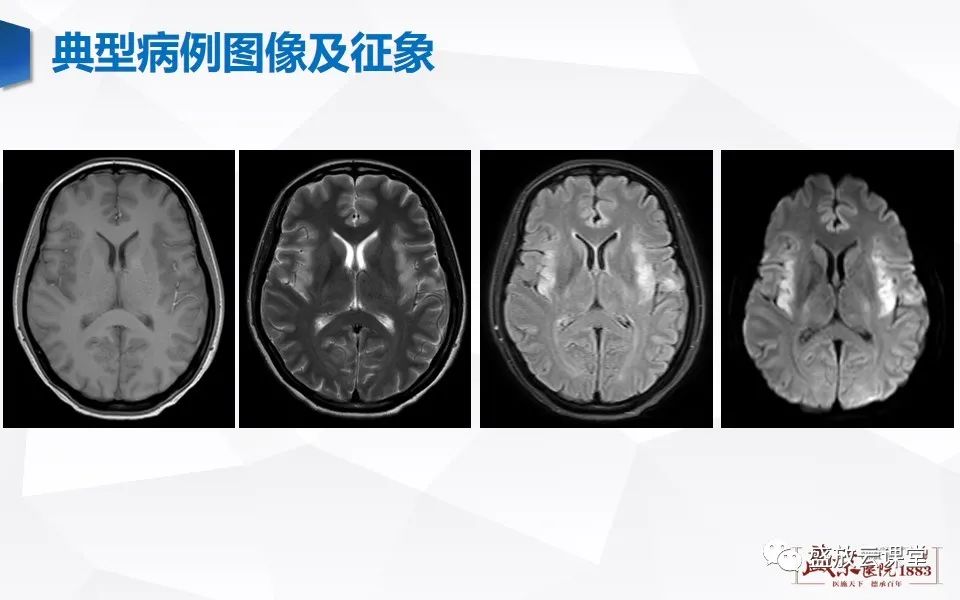 影像PPT - 【PPT】神经系统特殊感染（病毒性脑炎）-5