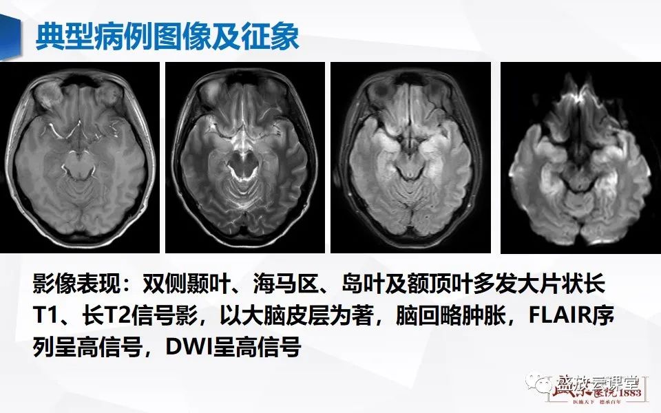 影像PPT - 【PPT】神经系统特殊感染（病毒性脑炎）-7