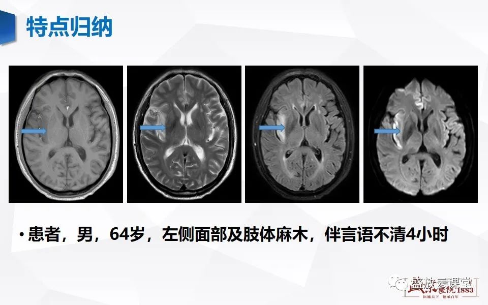 影像PPT - 【PPT】神经系统特殊感染（病毒性脑炎）-15