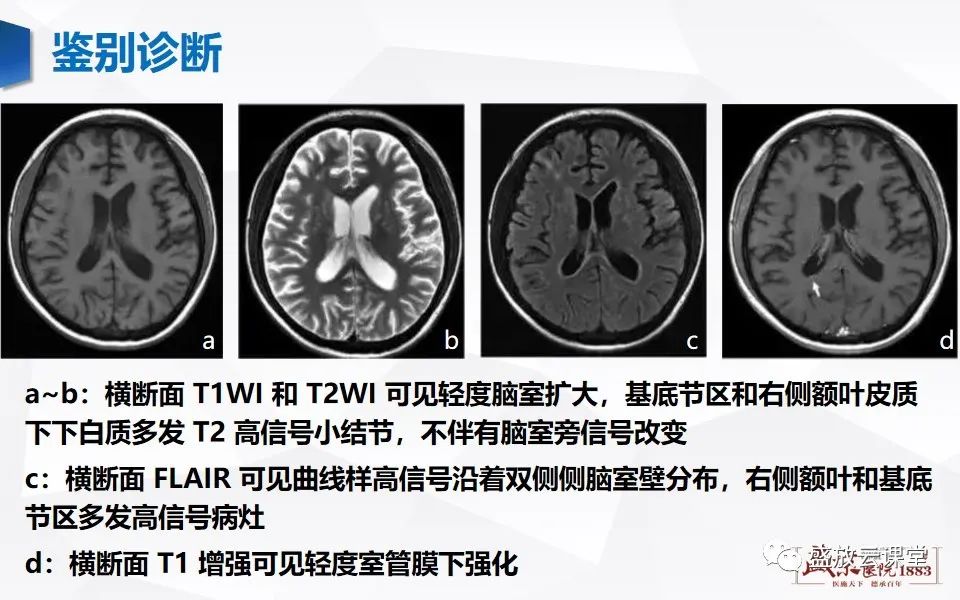 影像PPT - 【PPT】神经系统特殊感染（病毒性脑炎）-19