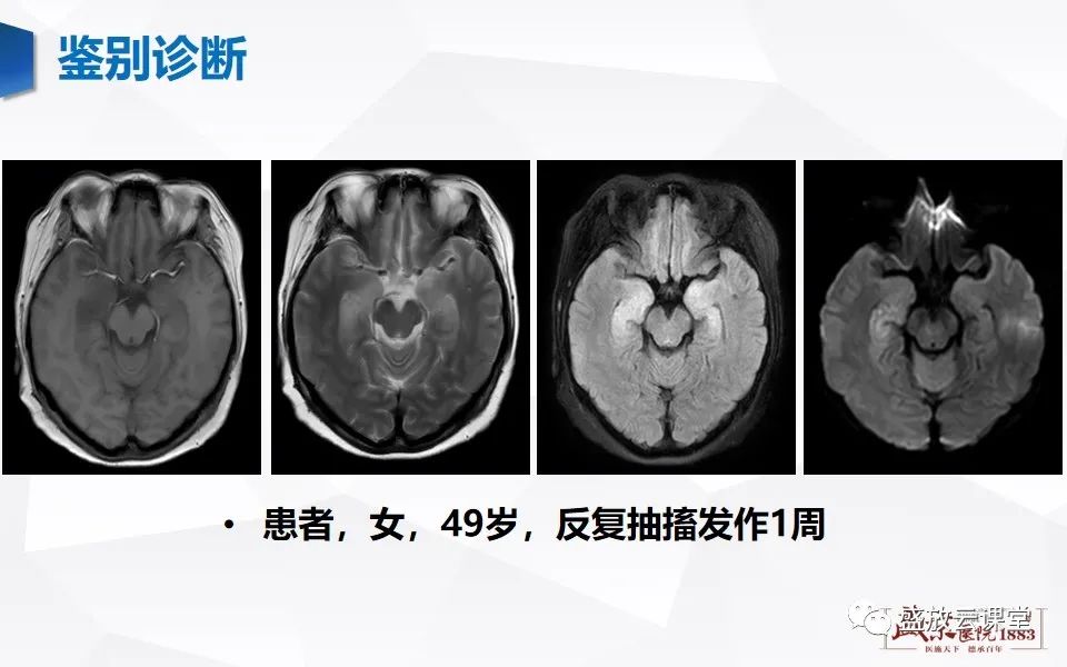影像PPT - 【PPT】神经系统特殊感染（病毒性脑炎）-26