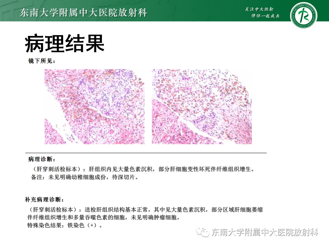影像PPT - 【PPT】肝脏铁过载-2 影像PPT - 【PPT】肝脏铁过载-2