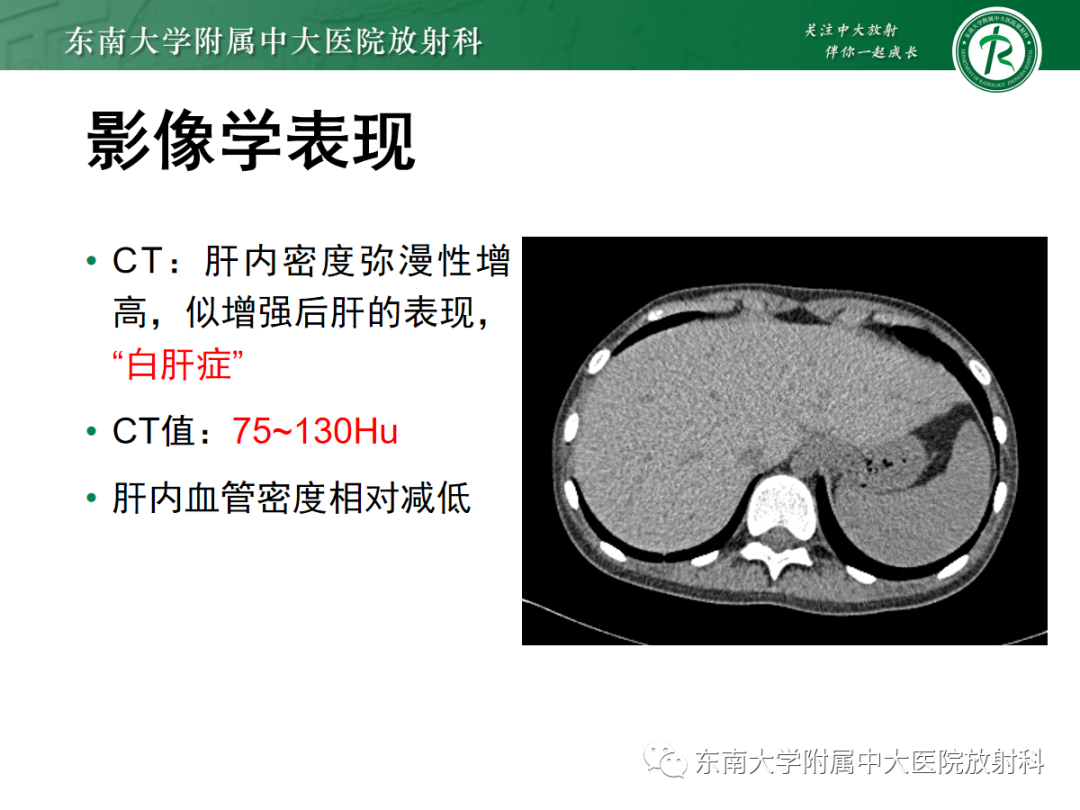 影像PPT - 【PPT】肝脏铁过载-11 影像PPT - 【PPT】肝脏铁过载-11