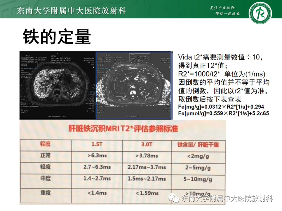 影像PPT - 【PPT】肝脏铁过载-14 影像PPT - 【PPT】肝脏铁过载-14