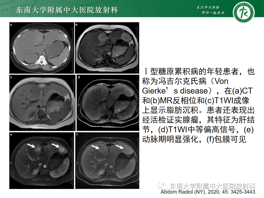 影像PPT - 【PPT】肝脏铁过载-18 影像PPT - 【PPT】肝脏铁过载-18
