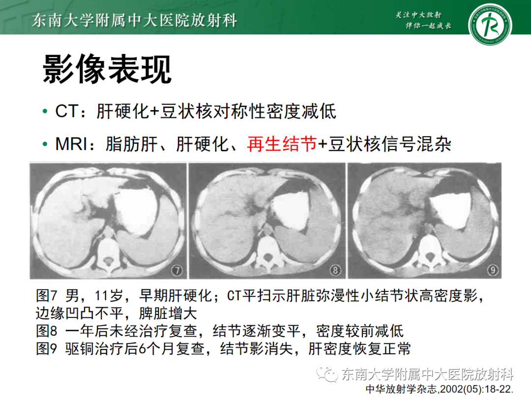 影像PPT - 【PPT】肝脏铁过载-21 影像PPT - 【PPT】肝脏铁过载-21