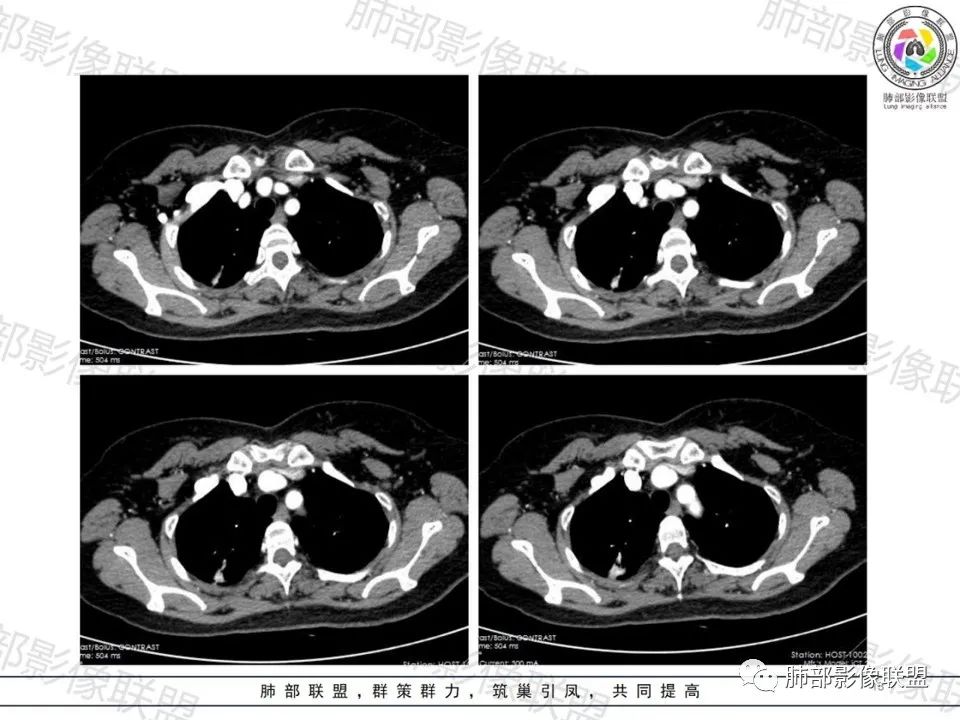 影像PPT - 【病例】一眼望穿的肺阴影—浸润性肺腺癌-13 影像PPT - 【病例】一眼望穿的肺阴影—浸润性肺腺癌-13