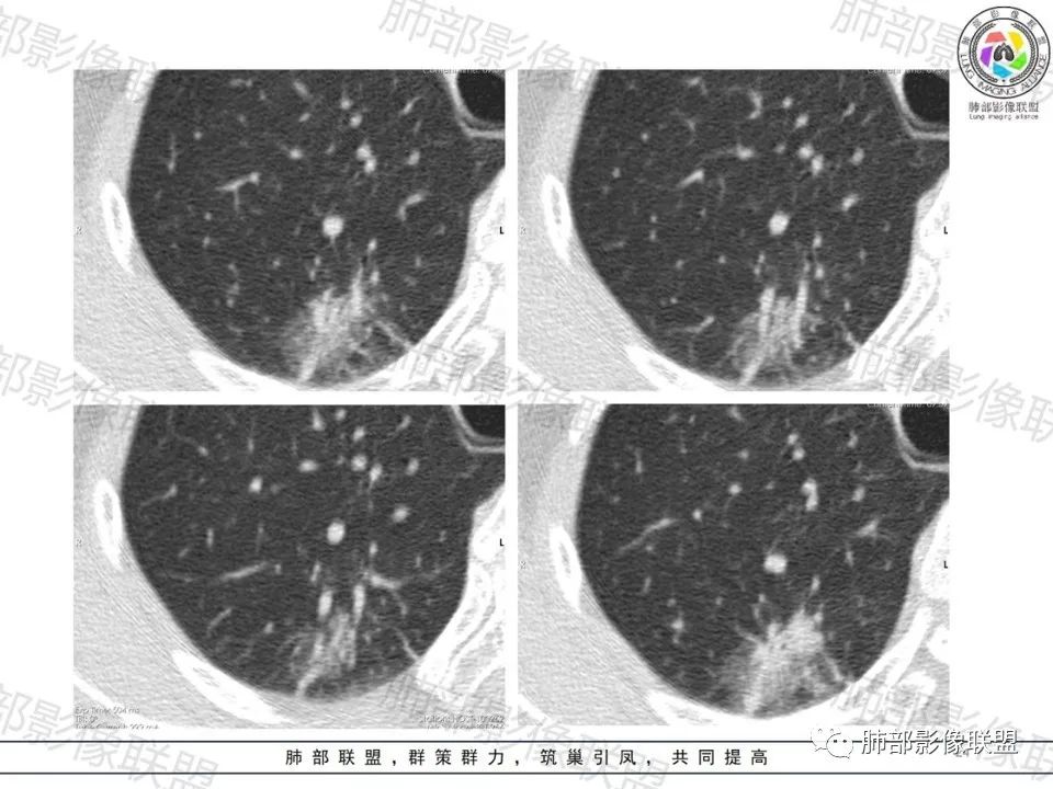 影像PPT - 【病例】一眼望穿的肺阴影—浸润性肺腺癌-24 影像PPT - 【病例】一眼望穿的肺阴影—浸润性肺腺癌-24