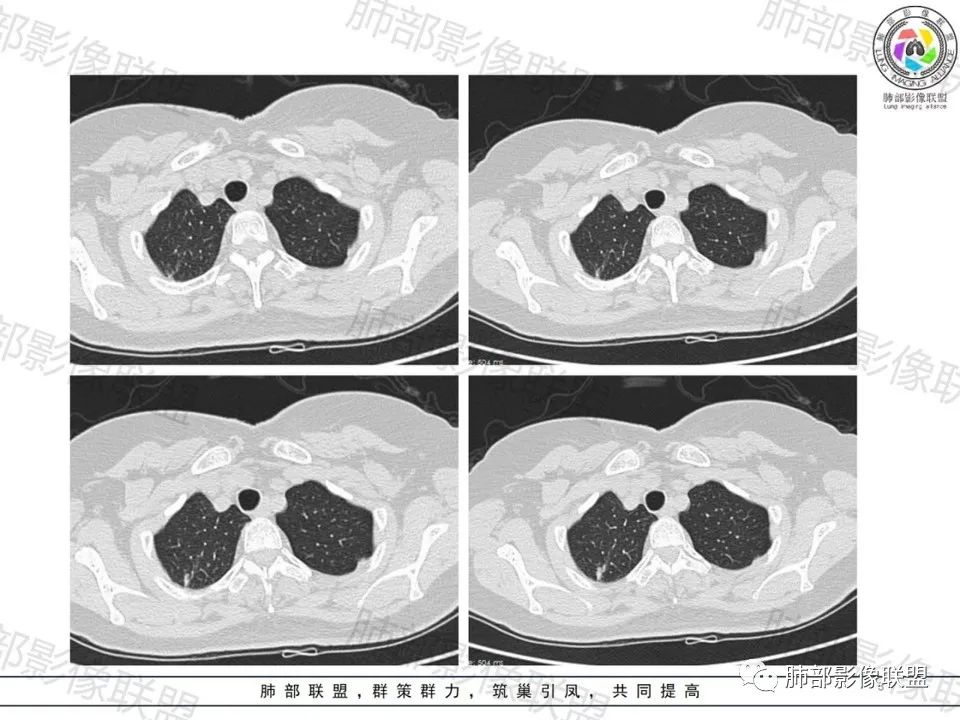影像PPT - 【病例】一眼望穿的肺阴影—浸润性肺腺癌-2 影像PPT - 【病例】一眼望穿的肺阴影—浸润性肺腺癌-2