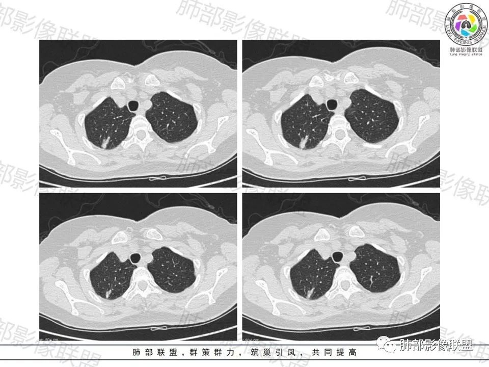 影像PPT - 【病例】一眼望穿的肺阴影—浸润性肺腺癌-3 影像PPT - 【病例】一眼望穿的肺阴影—浸润性肺腺癌-3