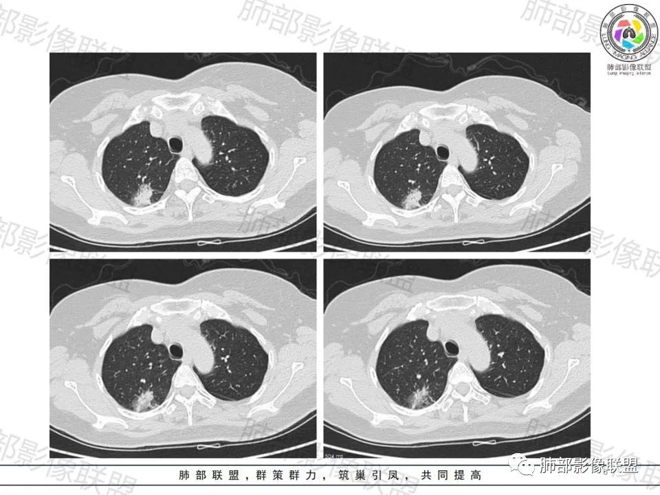 影像PPT - 【病例】一眼望穿的肺阴影—浸润性肺腺癌-5 影像PPT - 【病例】一眼望穿的肺阴影—浸润性肺腺癌-5