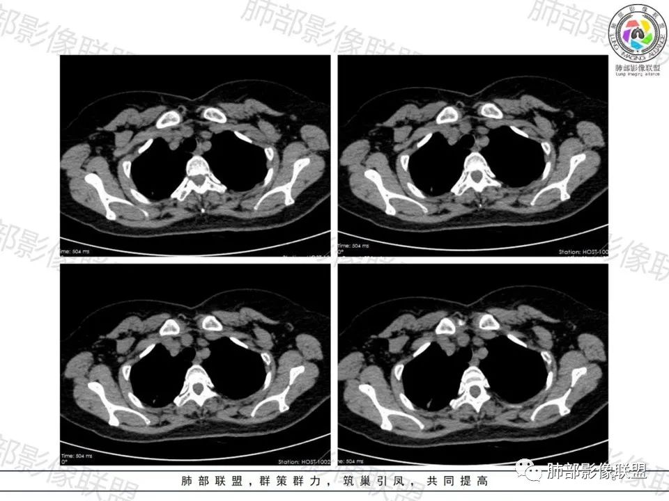 影像PPT - 【病例】一眼望穿的肺阴影—浸润性肺腺癌-7 影像PPT - 【病例】一眼望穿的肺阴影—浸润性肺腺癌-7