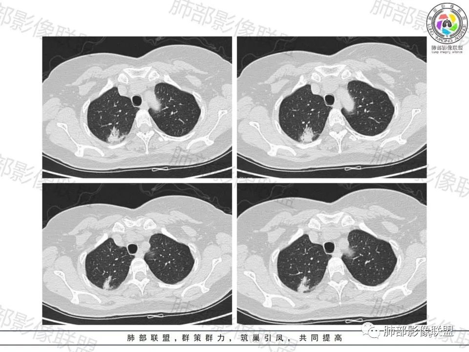影像PPT - 【病例】一眼望穿的肺阴影—浸润性肺腺癌-4 影像PPT - 【病例】一眼望穿的肺阴影—浸润性肺腺癌-4