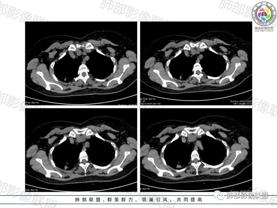 影像PPT - 【病例】一眼望穿的肺阴影—浸润性肺腺癌-8 影像PPT - 【病例】一眼望穿的肺阴影—浸润性肺腺癌-8