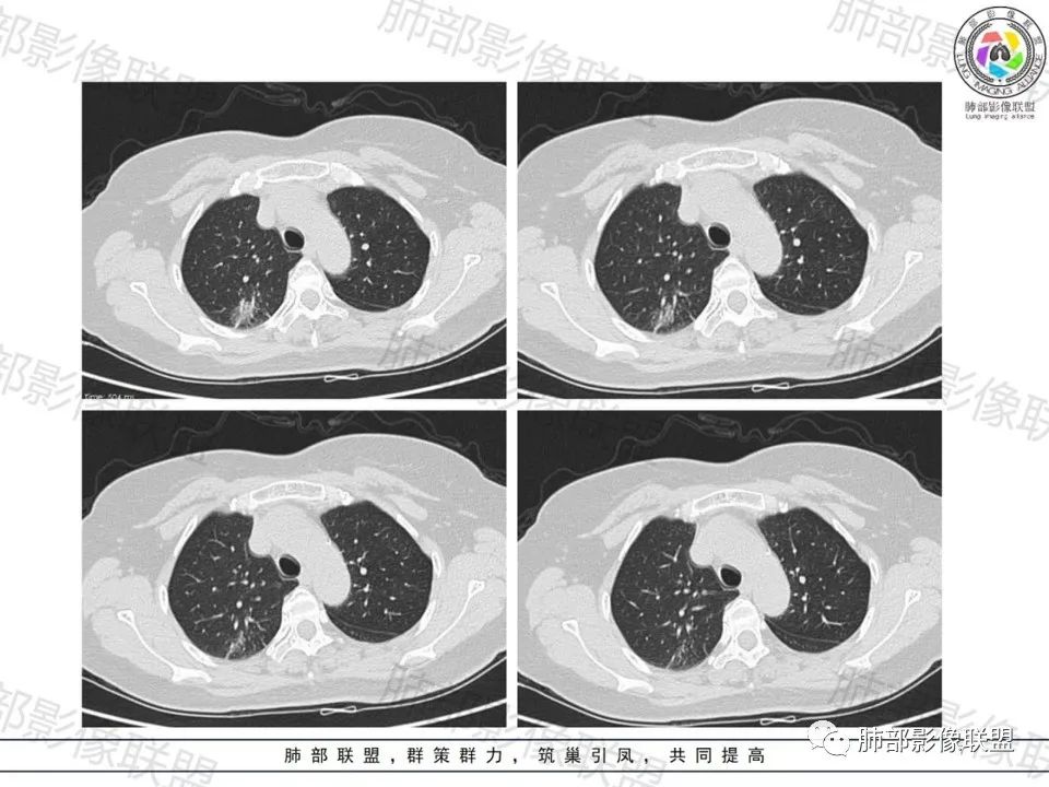 影像PPT - 【病例】一眼望穿的肺阴影—浸润性肺腺癌-6 影像PPT - 【病例】一眼望穿的肺阴影—浸润性肺腺癌-6