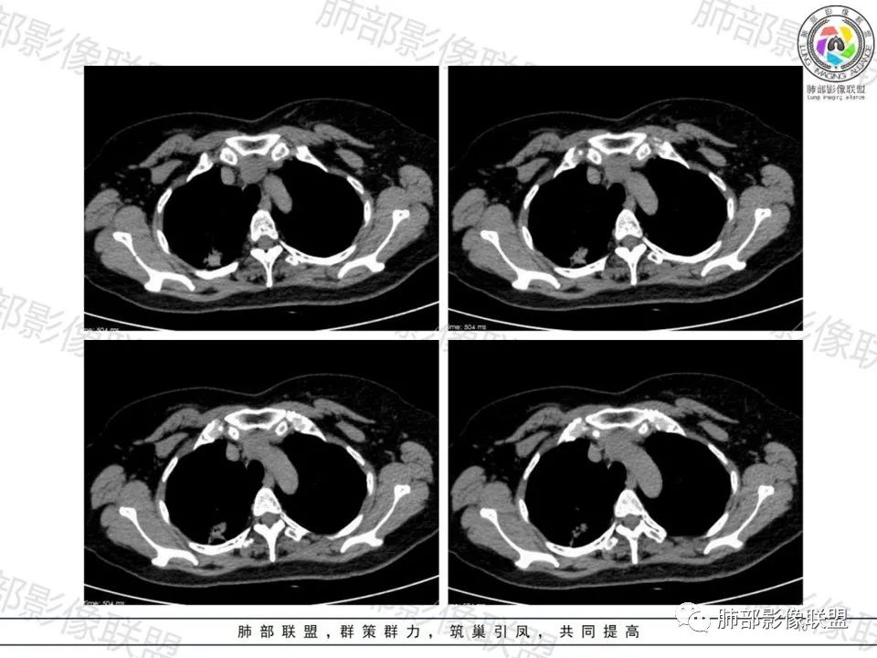 影像PPT - 【病例】一眼望穿的肺阴影—浸润性肺腺癌-9 影像PPT - 【病例】一眼望穿的肺阴影—浸润性肺腺癌-9