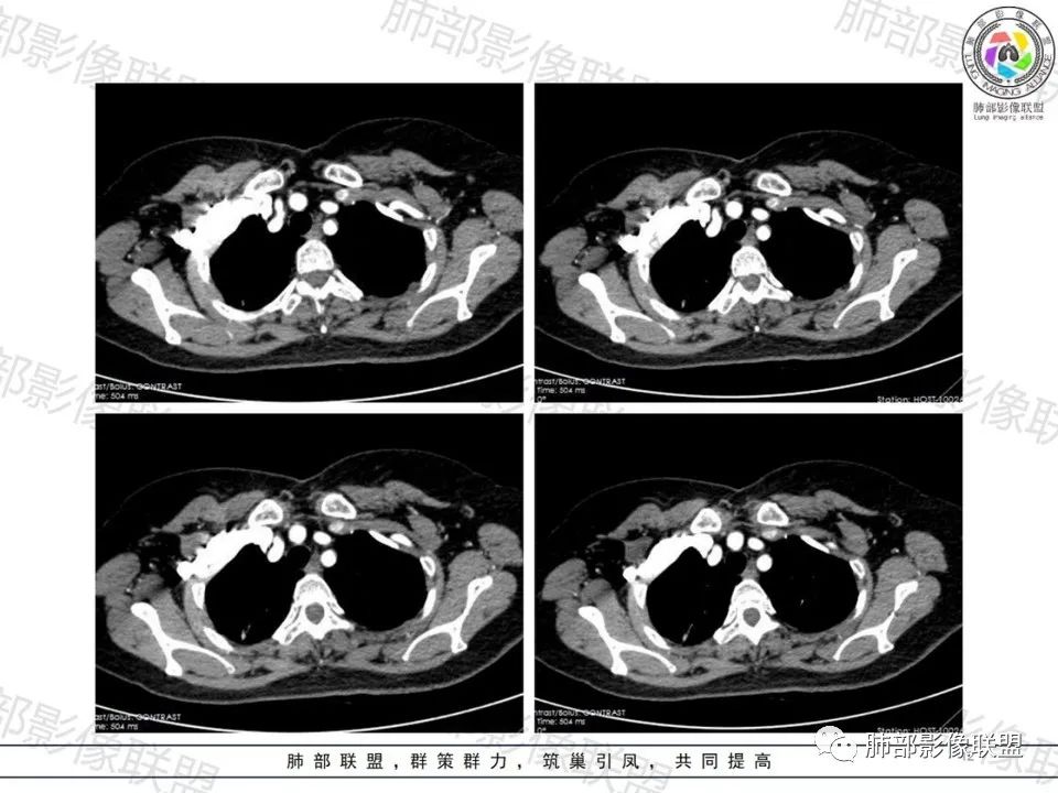 影像PPT - 【病例】一眼望穿的肺阴影—浸润性肺腺癌-11 影像PPT - 【病例】一眼望穿的肺阴影—浸润性肺腺癌-11