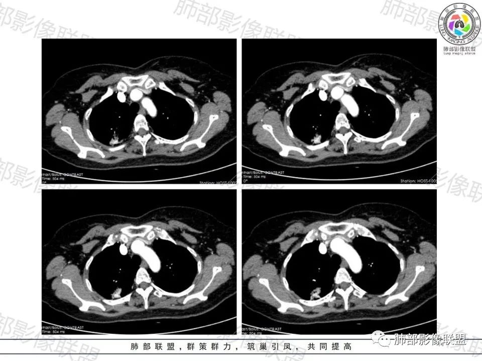 影像PPT - 【病例】一眼望穿的肺阴影—浸润性肺腺癌-12 影像PPT - 【病例】一眼望穿的肺阴影—浸润性肺腺癌-12