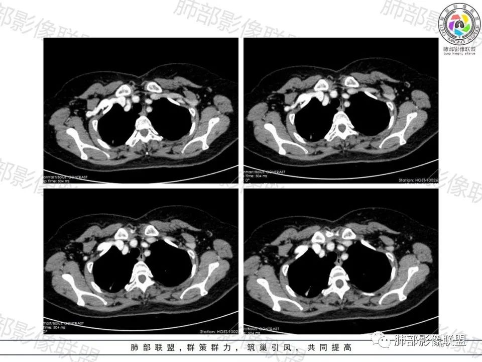 影像PPT - 【病例】一眼望穿的肺阴影—浸润性肺腺癌-13 影像PPT - 【病例】一眼望穿的肺阴影—浸润性肺腺癌-13