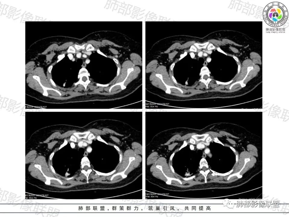 影像PPT - 【病例】一眼望穿的肺阴影—浸润性肺腺癌-14 影像PPT - 【病例】一眼望穿的肺阴影—浸润性肺腺癌-14